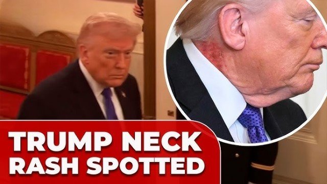 Muncul Ruam Merah Misterius di Leher Donald Trump, Tim Medis Gedung Putih Ungkap Fakta Mengejutkan!